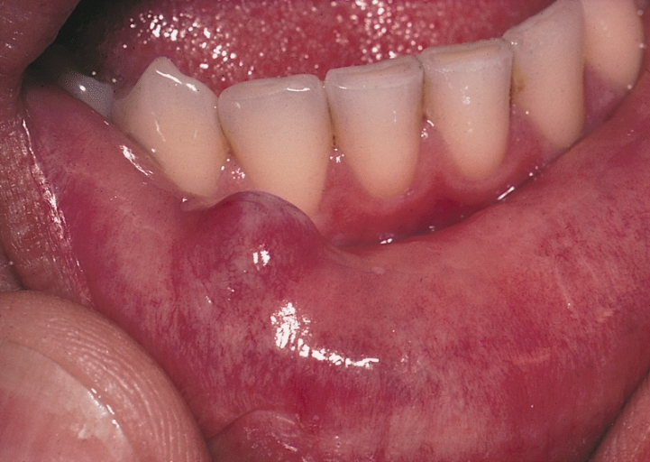 SALIVARY GLANDS: MUCOCELE. This extravasation type mucocele is a smooth-surfaced, dome-shaped nodule of the mucosa of the lower lip, the most common site for these lesions.
