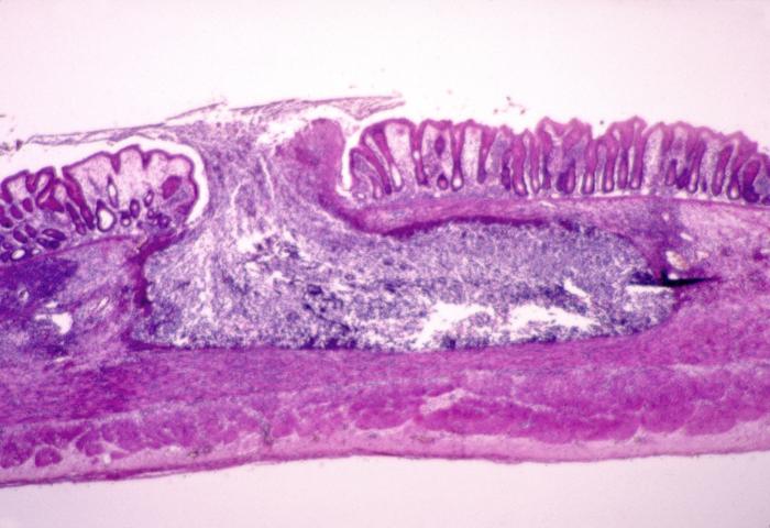 Intestinal amebiasis infection. Adapted from Public Health Image Library (PHIL). [1]