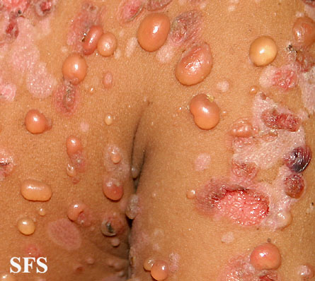 Childhood linear IgA disease. Adapted from Dermatology Atlas.[3]