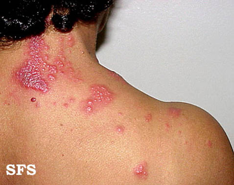 File:Herpes zoster 02.jpeg
