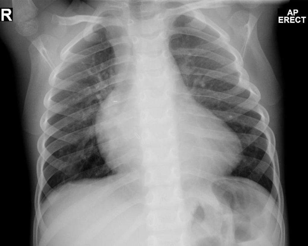 File:Congenital-pulmonary-stenosis.JPG