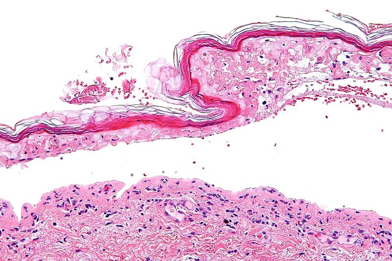 Histology of confluent epidermal necrosis (high mag),Source:By Nephron - Own work, CC BY-SA 3.0, https://commons.wikimedia.org/w/index.php?curid=16874054[10]