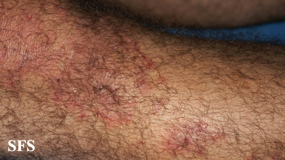 File:Dermatitis herpetiformis45.jpg