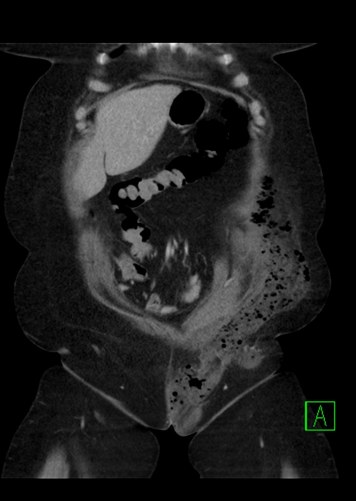 File:Fournier-gangrene CT.jpg