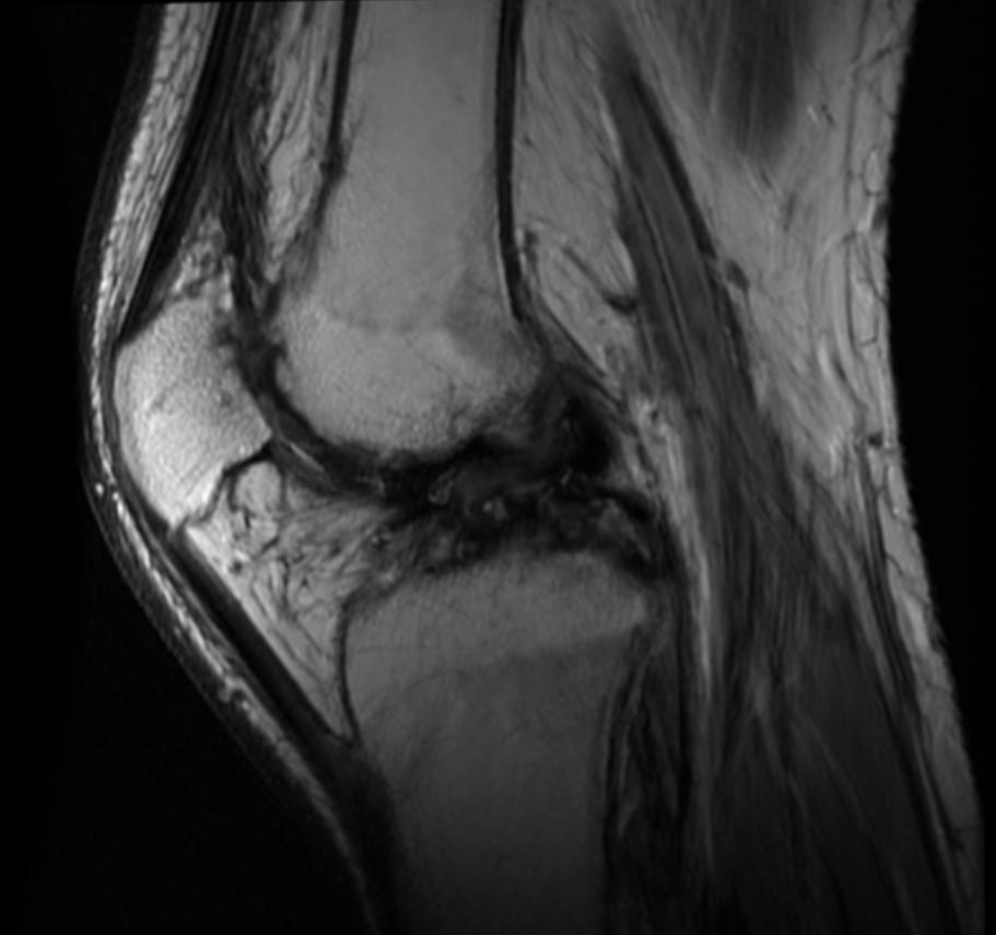 File:Hemophilia knee MRI 104.jpg