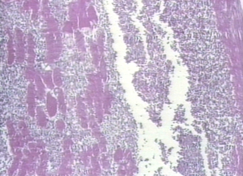 Microscopic histopathological image of pyomyositis[9]
