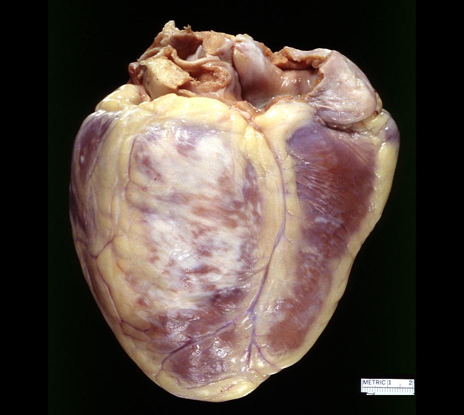 Myocardial infarction, fibrosis. Right Coronary Artery's territory