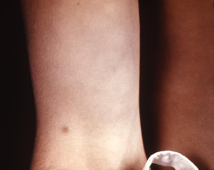 This patient presented with a case of syphilis during the secondary stage with the appearance of a papular forearm lesion. The second stage starts when one or more areas of the skin break into a rash that appears as rough, red or reddish brown spots both on the palms of the hands and on the bottoms of the feet. Even without treatment the rash clears up on its own. Adapted from CDC