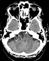 File:Acoustic.neuroma.ct.1.jpg