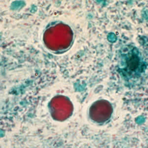 File:Bhominis cyst tric5.jpg