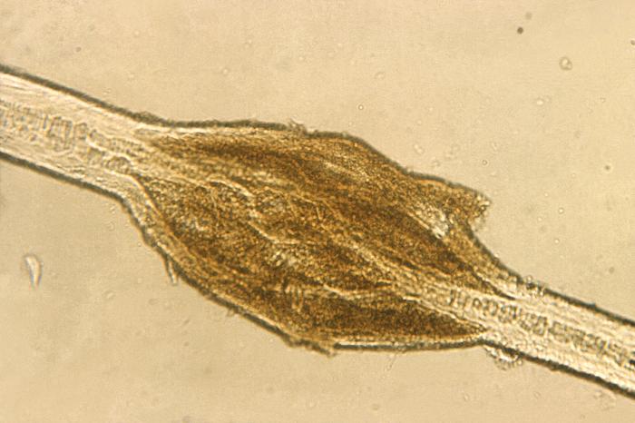 Under a relatively-low magnification of 100X, this photomicrograph reveals some of the pathologic morphology displayed by a primate hair shaft indicative of the disease known as, “black piedra”, also known as “trichosporosis”, which is caused by the fungal organism, Piedraia hortae. From Public Health Image Library (PHIL). [2]