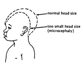 Diagram of microcephaly