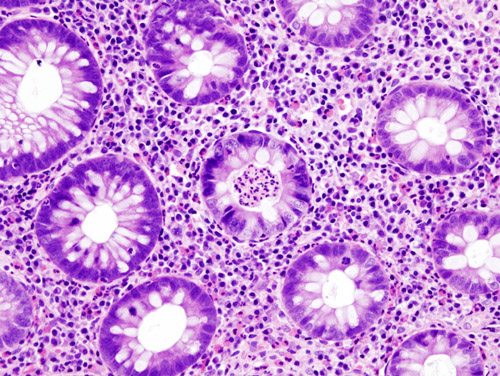 Ulcerative colitis. H&E staining showing crypt abscess, a characteristic finding in ulcerative colitis [17]