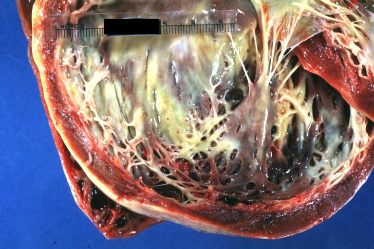 Cardiomyopathy: Gross dilated left ventricle with marked endocardial thickening this is what has been called adult fibroelastosis