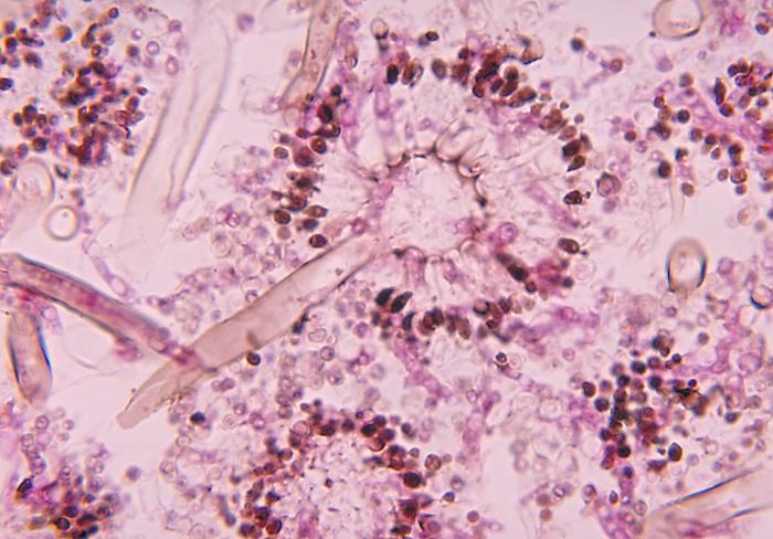 This micrograph depicts the histopathologic features of aspergillosis including the presence of conidial heads.From Public Health Image Library (PHIL). [2]