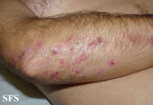 File:Dermatitis herpetiformis18.jpg