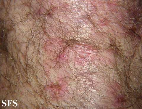 File:Dermatitis herpetiformis23.jpg