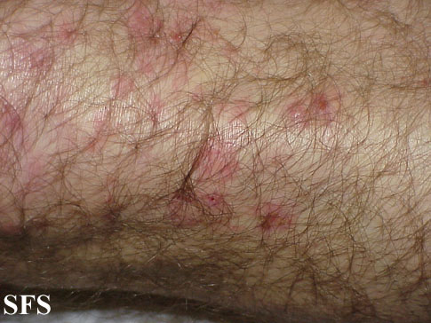 File:Dermatitis herpetiformis24.jpg