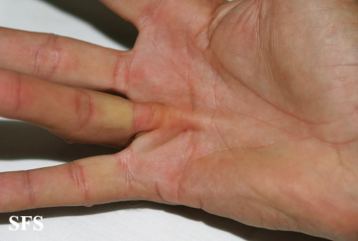 Dupuytren contracture. Adapted from Dermatology Atlas.[4]