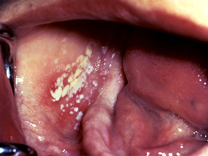 Oral pseudomembranous candidiasis infection. From Public Health Image Library (PHIL). [3]