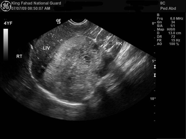 Neuroblastoma observed on ultrasound as a large right suprarenal mass with heterogeneous echogenicity.[1]