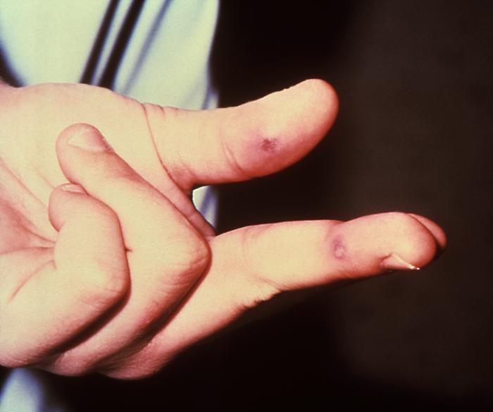 The lesion on this patient’s left hand was due to the systemic dissemination of the Neisseria gonorrhoeae bacteria. Though sexually transmitted, and involving the urogenital tract initially, a Neisseria gonorrhoeae bacterial infection can become disseminated systemically, manifesting itself as a cutaneous erythematous lesion anywhere on the body. Adapted from CDC