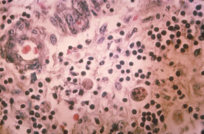 Histopathology of amebiasis. Adapted from Public Health Image Library (PHIL). [1]