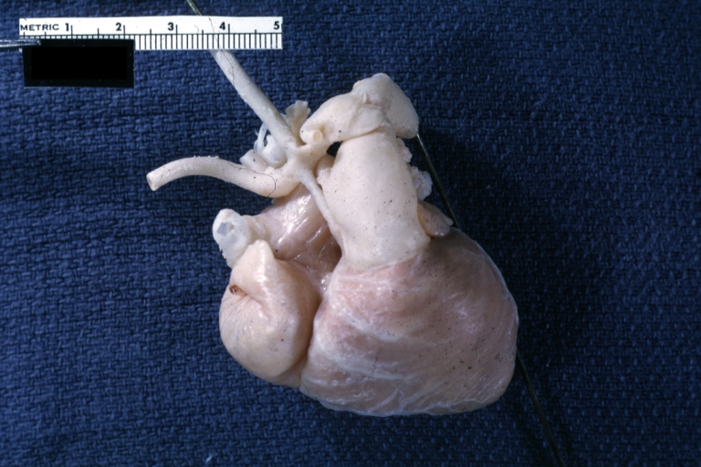 Hypoplastic left ventricle
