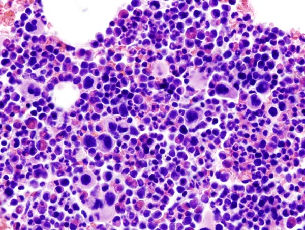 Histopathological image representing a bone marrow aspirate in a patient with essential thrombocythemia. Hematoxylin & eosin stain.[12]
