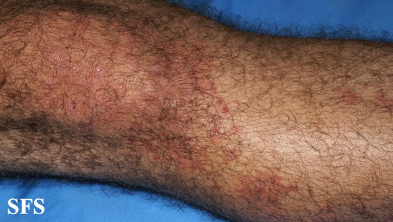 File:Dermatitis herpetiformis44.jpg