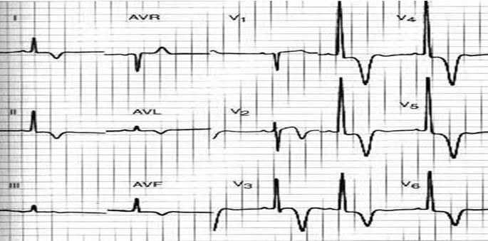 A variant of apical hypertrophic cardiomyopathy. Deeply inverted T waves in precordial leads V2-V6 and II, III, aVL.