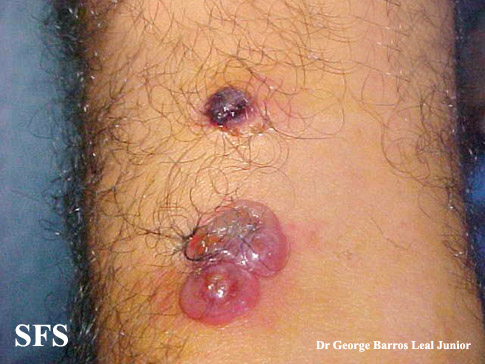 Orf. With pemission from Dermatology Atlas.[2]