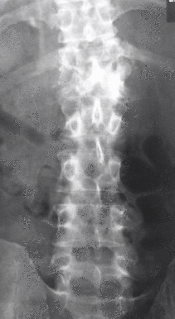 Pott's disease x ray - wikidoc