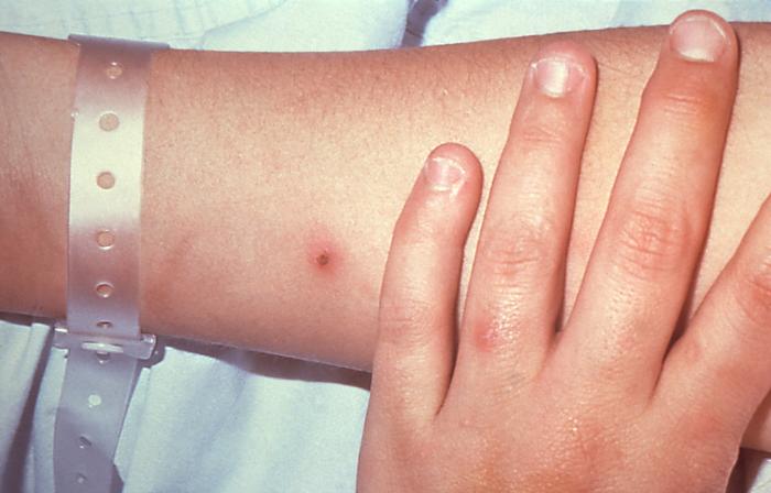 This patient presented with cutaneous lesions on the right forearm and left hand due to a N. gonorrhoeae infection. Though sexually transmitted, and involving the urogenital tract initially, a Neisseria gonorrhoeae bacterial infection can become disseminated systemically, manifesting itself as a cutaneous erythematous lesion anywhere on the body. Adapted from CDC