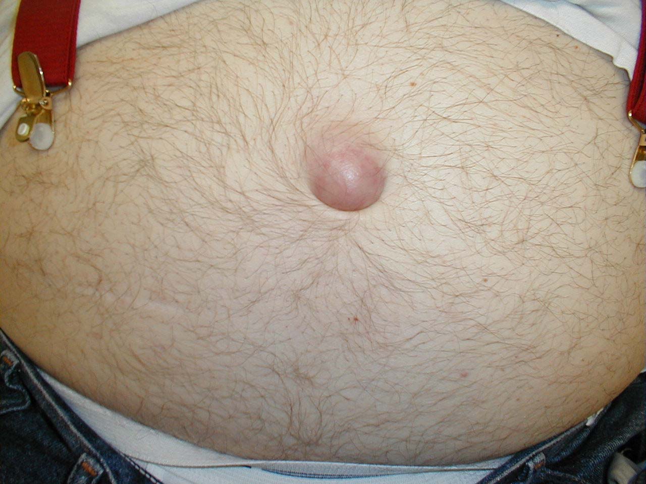 Incarcerated Umbilical Hernia: Note reddened umbilical area resulting from entrapment of intra-abdominal contents in hernia. When this occurred, the patient developed acute pain in this region.