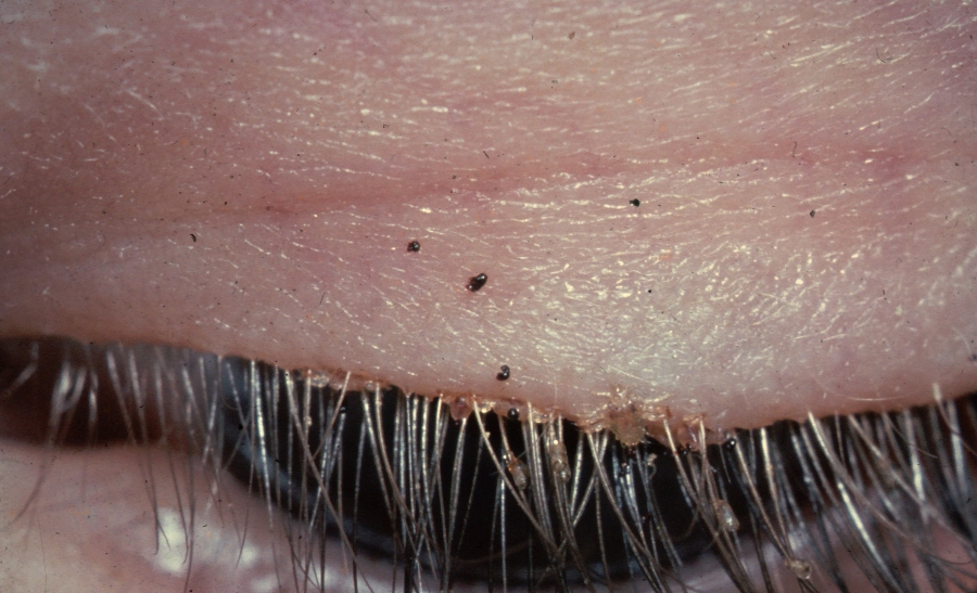 Fig.3 Pubic lice on eye-lashes