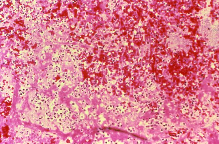 Histopathology of spleen in fatal human plague. Necrosis and Yersinia pestis Adapted from Public Health Image Library (PHIL), Centers for Disease Control and Prevention.[15]