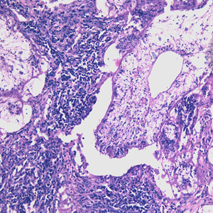 Proliferating sparganum in lung tissue in a patient from Taiwan, stained with hematoxylin and eosin (H&E). Adapted from CDC