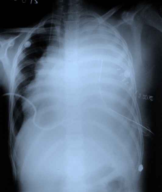 File:Tuberculous pericarditis.jpg