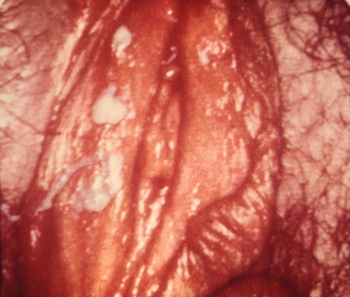 Female perineum highlights the inflammatory reaction known as vulvitis, or vulvovaginal candidiasis, which in this case, was caused by an infection by the fungal organism, Candida albicans. From Public Health Image Library (PHIL). [1]