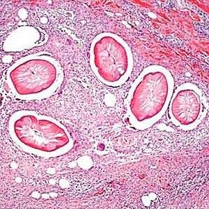 Cross-sections of Dirofilaria sp. from a subcutaneous nodule above the right breast of a female patient who traveled to several western European countries, stained with H&E. Image taken at 100x magnification. Image courtesy of Dr. Truus Derks. Adapted from CDC