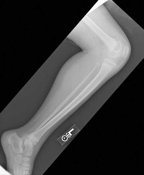 Hemophilic arthropathy involving the bilateral knees