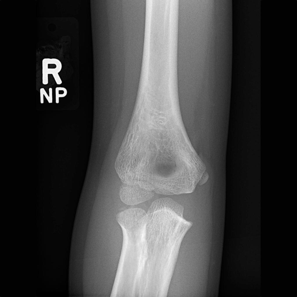 File:Lateral-condyle-fracture-3.jpg
