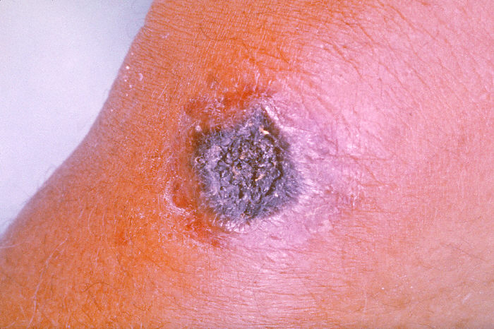 "Anthrax lesion on the skin of the forearm caused by the bacterium Bacillus anthracis”Adapted from Public Health Image Library (PHIL), Centers for Disease Control and Prevention.[20]