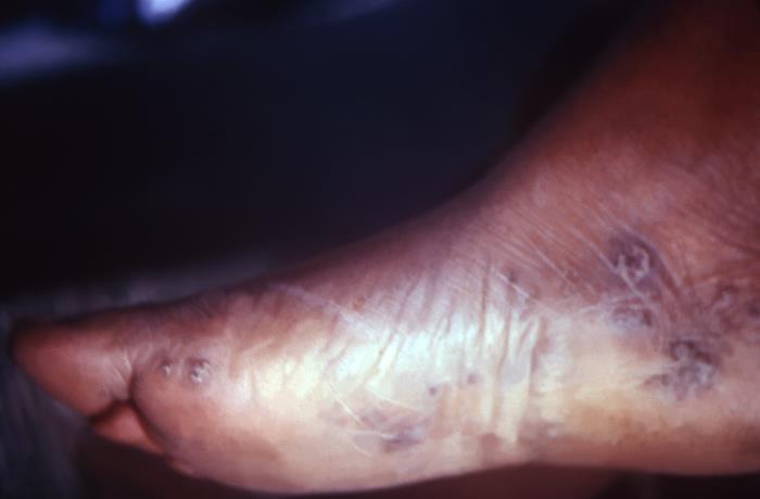 Note the keratotic secondary syphilitic lesions on the sole of this patient's right foot. The second stage starts when one or more areas of the skin break into a rash that appears as rough, red or reddish brown spots both on the palms of the hands and on the bottoms of the feet. Even without treatment, rashes clear up on their own. Adapted from CDC