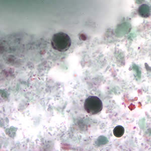 B. hominis cyst-like forms stained with trichrome. The nuclei in the peripheral cytoplasmic rim are visible, staining purple. Adapted from CDC