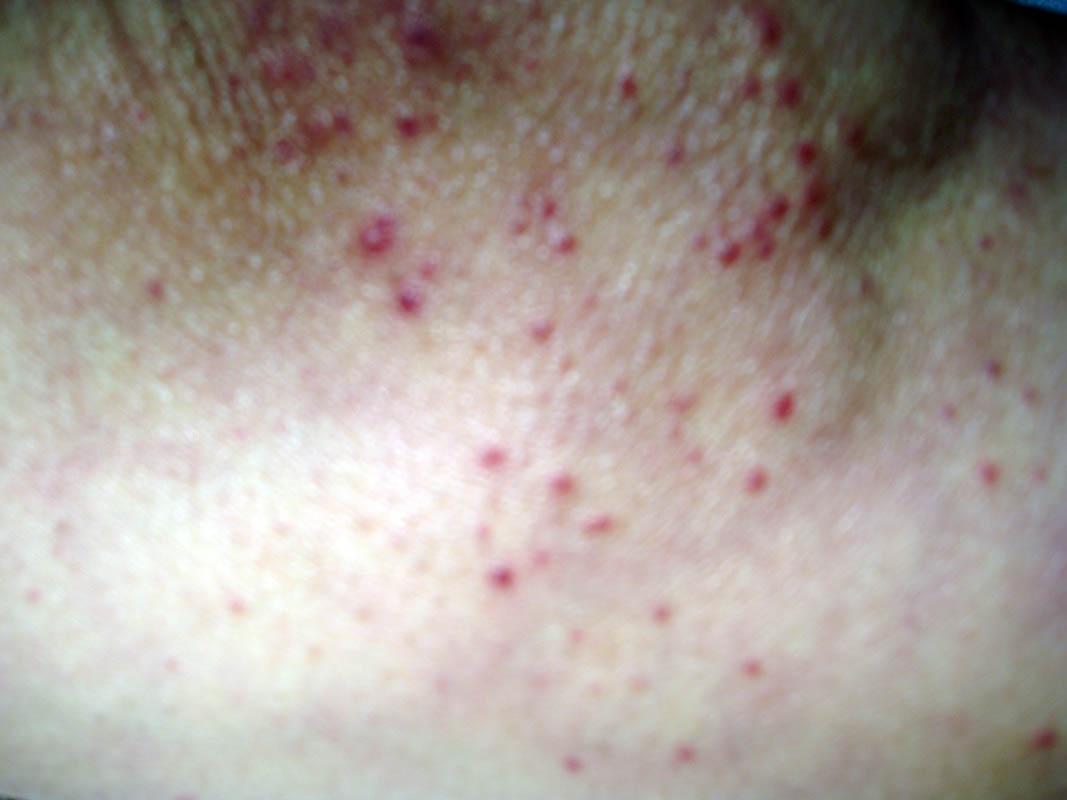File:Skin vasculitis5.jpg