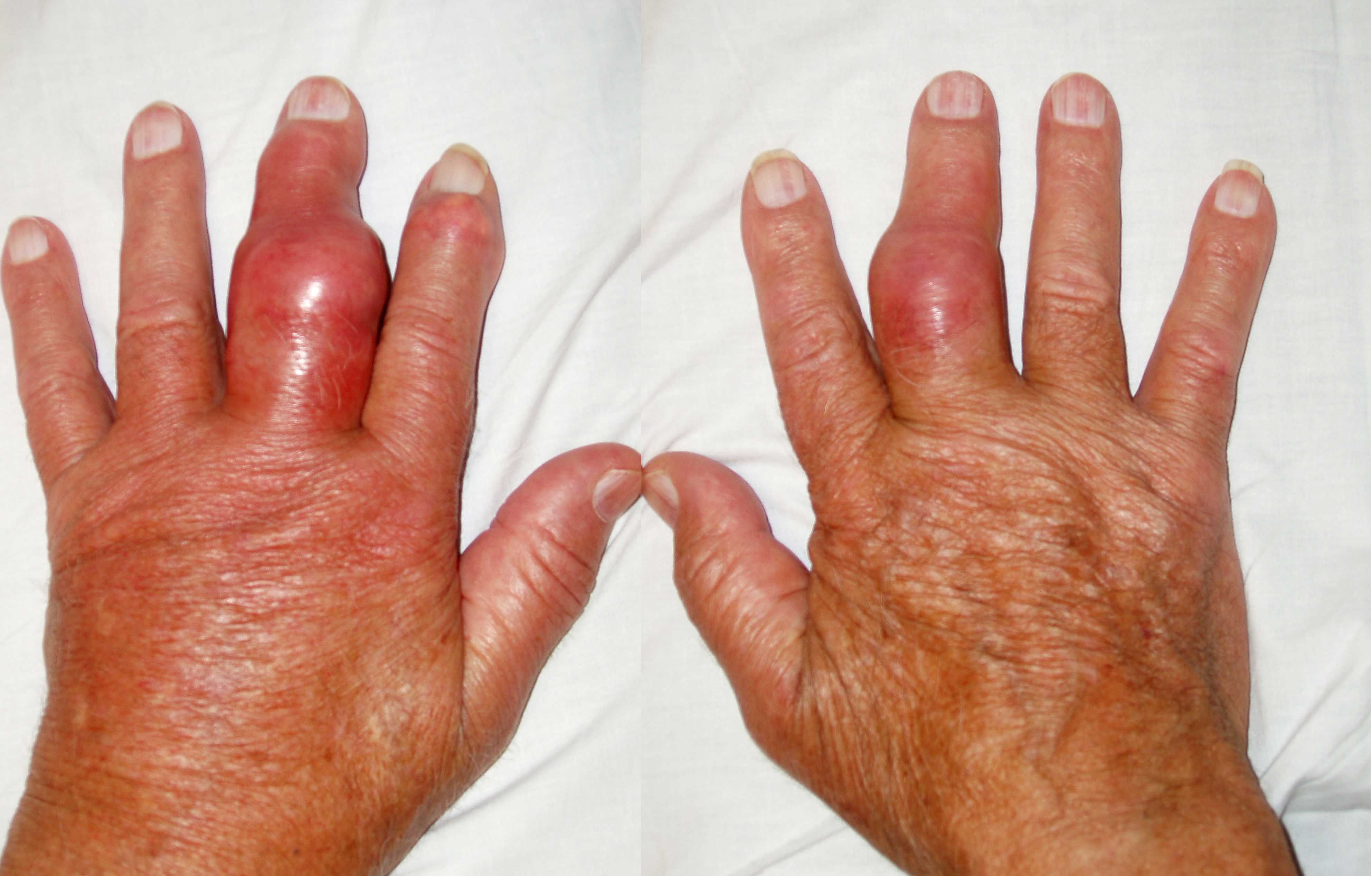 ... area a normal wrist for comparison tophaceous gout tophaceous gout