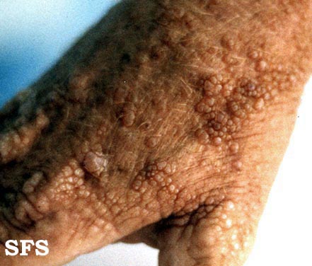 Colloid milium. Adapted from Dermatology Atlas.[2]