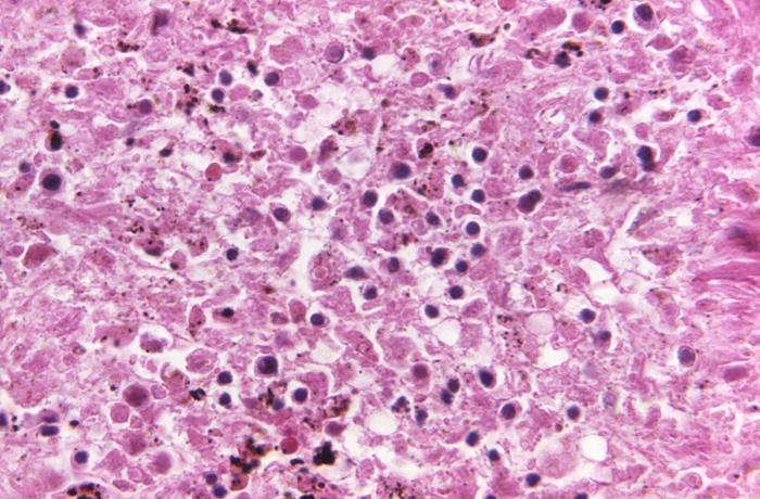 Magnification of 500X, this hematoxylin and eosin-stained splenic tissue sample revealing the histopathologic changes indicative of what was diagnosed as a case of fatal human plague from the country of Nepal Adapted from Public Health Image Library (PHIL), Centers for Disease Control and Prevention.[15]